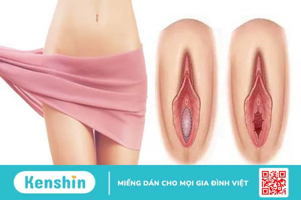 Không có màng trinh bẩm sinh có ảnh hưởng đến sức khỏe sinh sản không?