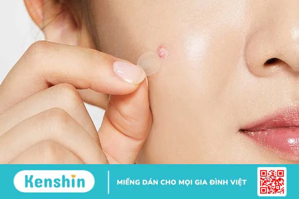 Không còn lo mụn với miếng dán mụn ban ngày Derma Angel