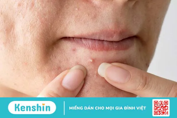 Không còn lo mụn với Miếng dán mụn ban ngày Derma Angel 1