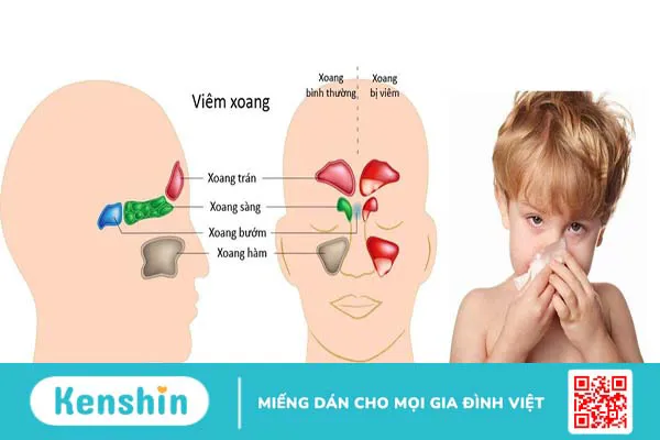 Không còn nỗi lo xoang mũi ở trẻ với bộ rửa xoang mũi Otosan Nasal Wash Kit