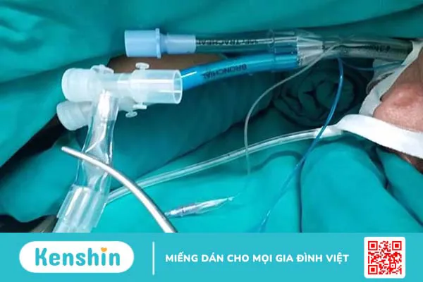 Kỹ thuật đặt ống nội khí quản 2 nòng là gì?