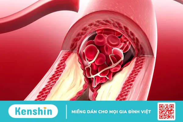 Kỹ thuật đo ABI là gì? Chỉ định và chống chỉ định của nghiệm pháp đo ABI