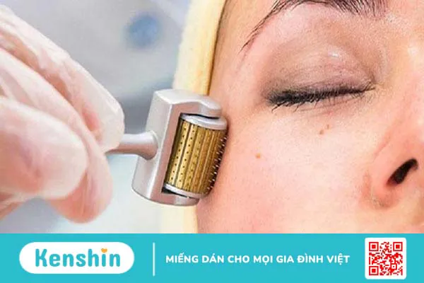 Lăn kim bao nhiêu tiền? Cơ chế của phương pháp lăn kim