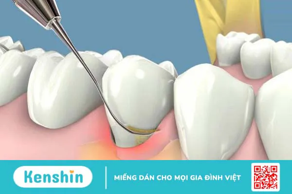 Lấy cao răng bằng máy siêu âm: Ưu điểm, quy trình và những lưu ý cần biết