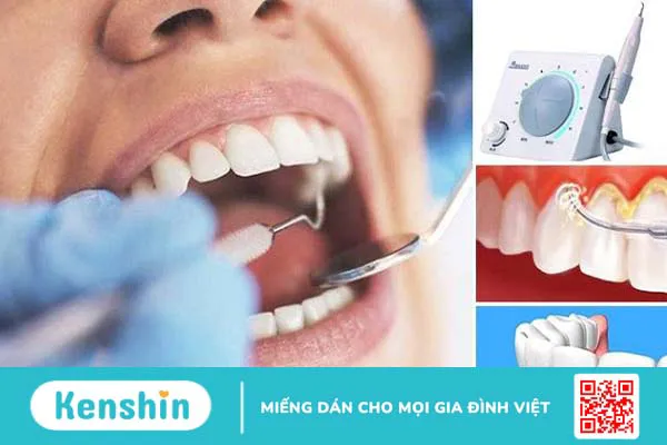 Lấy cao răng bằng máy siêu âm: Ưu điểm, quy trình và những lưu ý cần biết 3