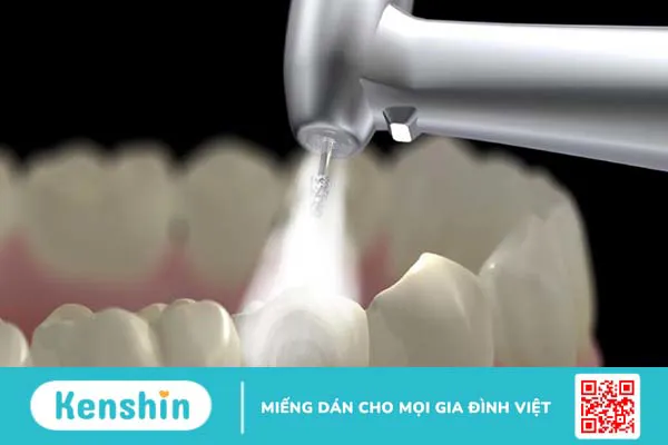 Lấy cao răng bằng máy siêu âm: Ưu điểm, quy trình và những lưu ý cần biết 2