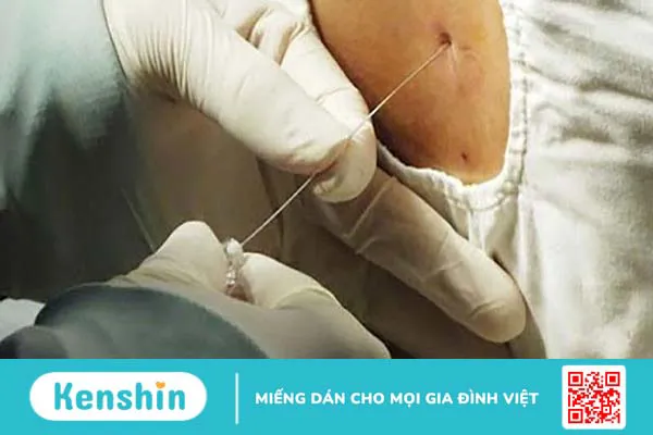 Lấy sinh thiết có nguy hiểm không? Ai được chỉ định lấy sinh thiết?