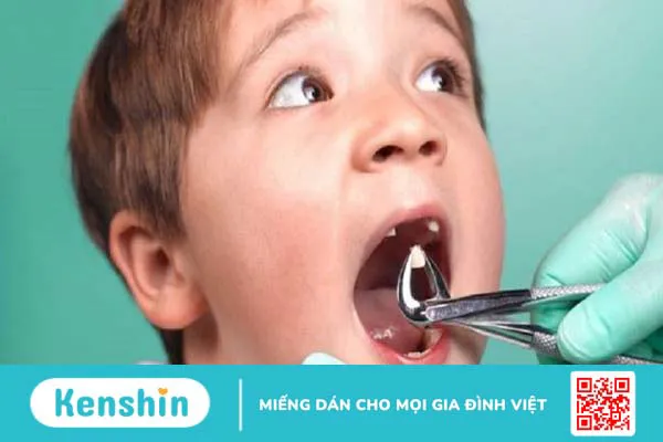 Lấy tủy răng sữa có nguy hiểm không?