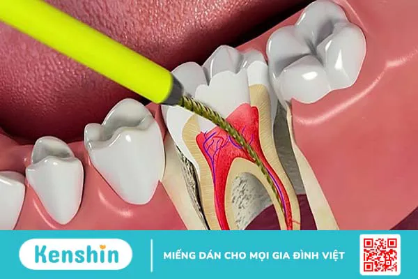 Lấy tủy răng sữa có nguy hiểm không?