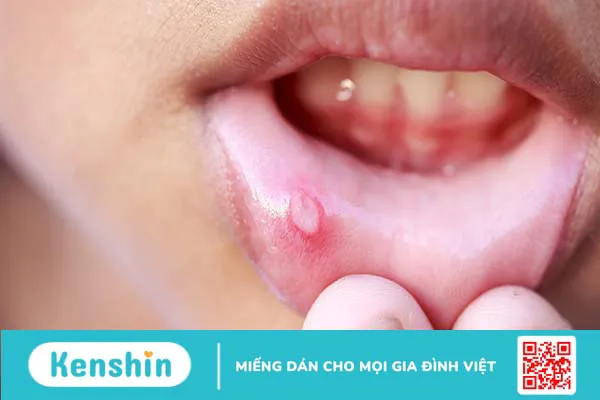 Lở miệng ở môi kéo dài có nguy hiểm không?