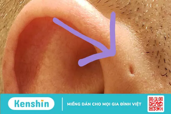 Lỗ ở tai bẩm sinh là bệnh gì? Có nguy hiểm không?