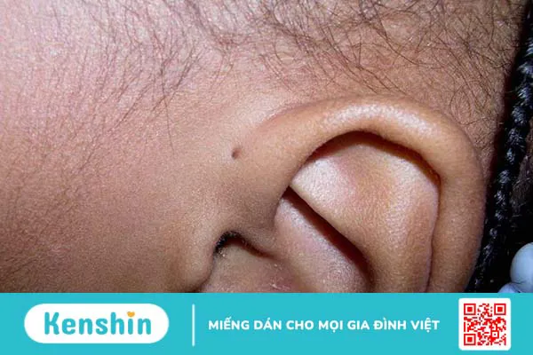 Lỗ ở tai bẩm sinh là bệnh gì? Có nguy hiểm không?