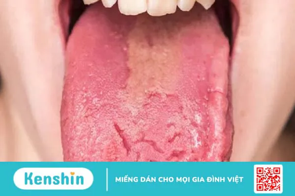 Lưỡi nứt bẩm sinh: Nguyên nhân và triệu chứng nhận biết bệnh