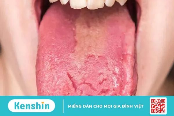 Lưỡi nứt bẩm sinh: Nguyên nhân và triệu chứng nhận biết bệnh 1