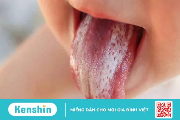 Lưỡi nứt bẩm sinh: Nguyên nhân và triệu chứng nhận biết bệnh 2