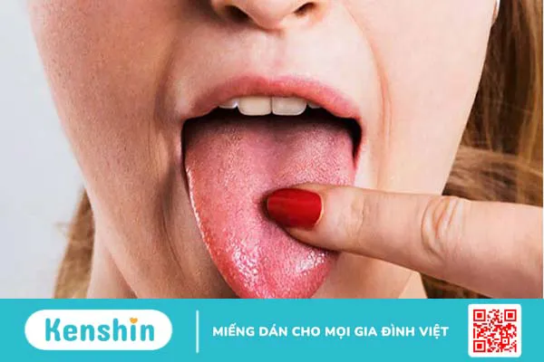 Lưỡi nứt bẩm sinh: Nguyên nhân và triệu chứng nhận biết bệnh 4