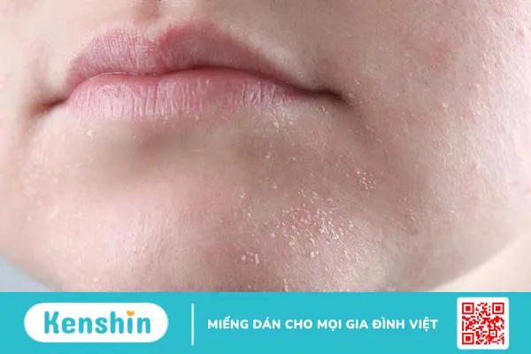 Lưu ý một số tác dụng phụ khi dùng BHA 2