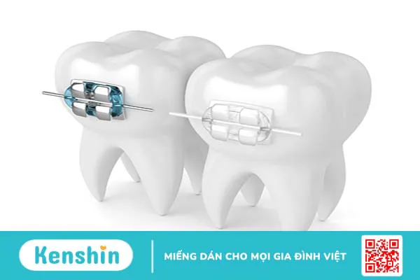 Mắc cài sứ và mắc cài pha lê: Nên lựa chọn loại nào?