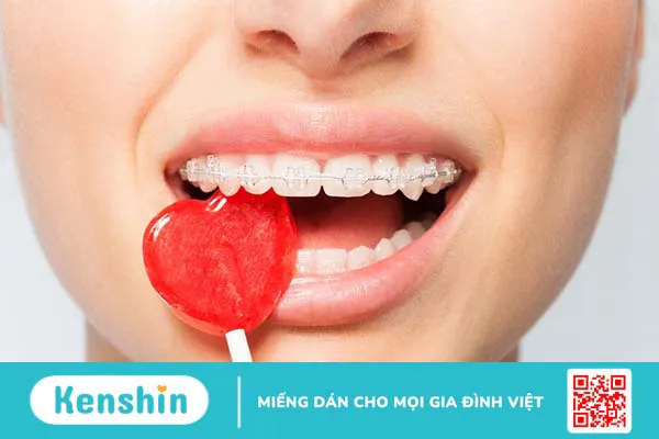 Mắc cài sứ và mắc cài pha lê: Nên lựa chọn loại nào?