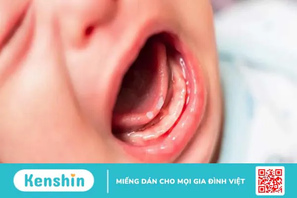 Mách mẹ các cách hỗ trợ trị nhiệt miệng ở trẻ sơ sinh hiệu quả