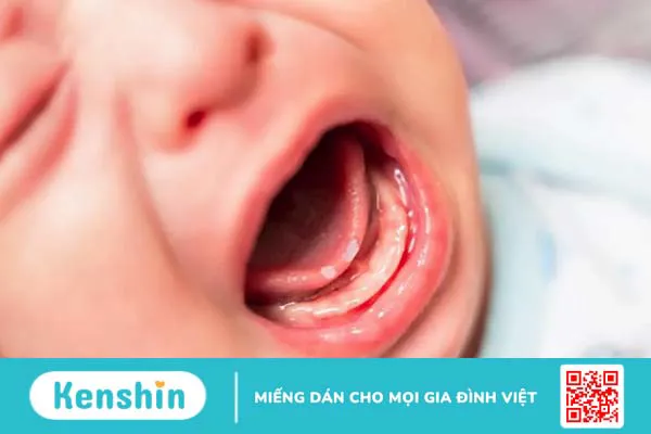 Mách mẹ các cách trị nhiệt miệng ở trẻ sơ sinh hiệu quả 1