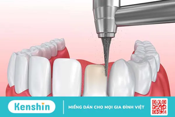 Mài cùi răng có ảnh hưởng đến sức khỏe răng miệng không?