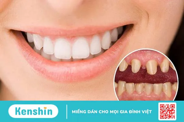 Mài cùi răng có ảnh hưởng đến sức khỏe răng miệng không?