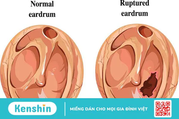 Màng nhĩ có cấu tạo như thế nào? Các bệnh lý về màng nhĩ 3