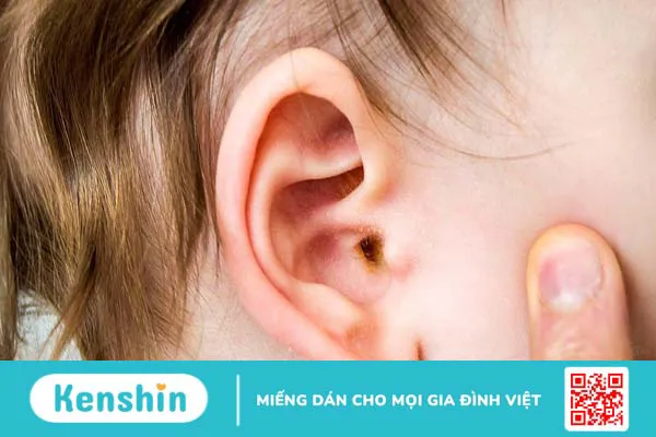 Màng nhĩ dễ bị thủng do đâu? Màng nhĩ bị thủng có tự liền được hay không?