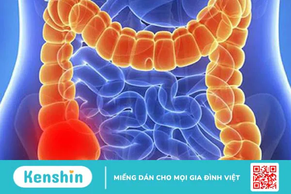 Manh tràng là gì? Các bệnh ở manh tràng thường gặp và cách phòng tránh