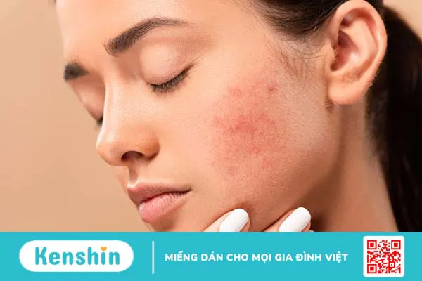 Mask diếp cá: 4 công thức làm đẹp da hiệu quả và đơn giản ngay tại nhà