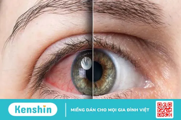 mắt bị khô rát: nguyên nhân và cách khắc phục 1