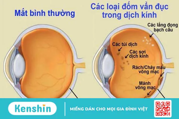 Mắt bị vẩn đục dịch kính: Nguyên nhân, triệu chứng và hướng điều trị