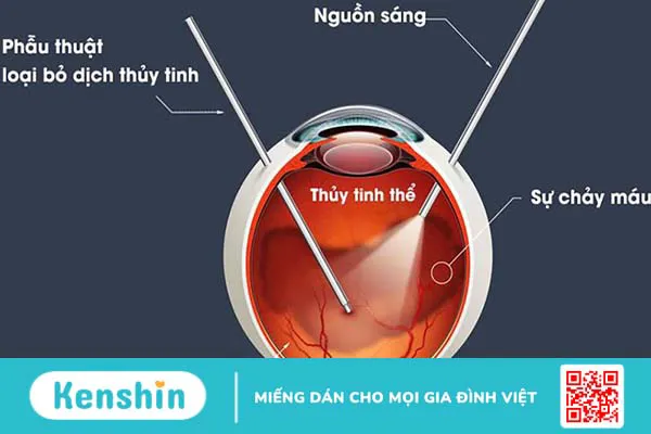 Mắt bị vẩn đục dịch kính: Nguyên nhân, triệu chứng và hướng điều trị