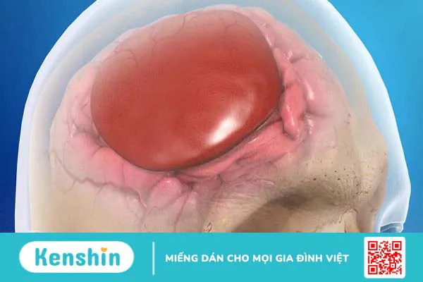 Máu tụ dưới màng cứng cấp tính: Nguyên nhân và điều trị 1