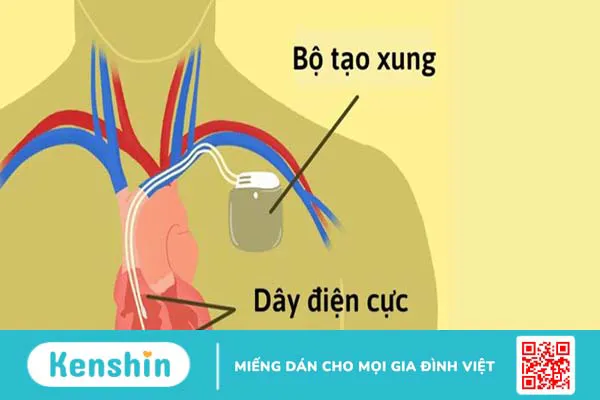 Máy tạo nhịp tim có an toàn không?