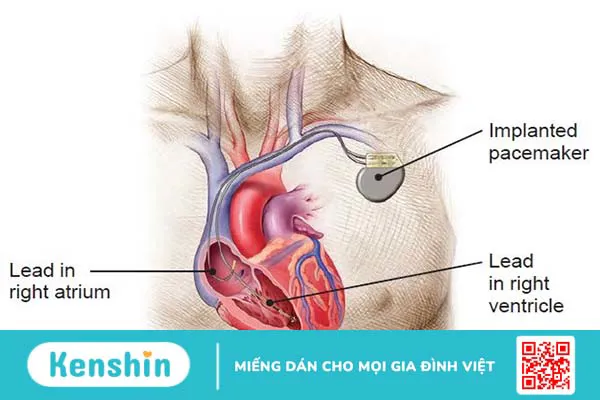 Máy tạo nhịp tim có an toàn không?