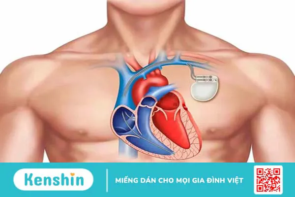 Máy tạo nhịp tim vĩnh viễn: Theo dõi nhịp tim tự động