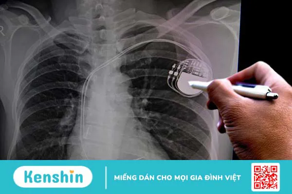 Máy tạo nhịp tim vĩnh viễn: Theo dõi nhịp tim tự động