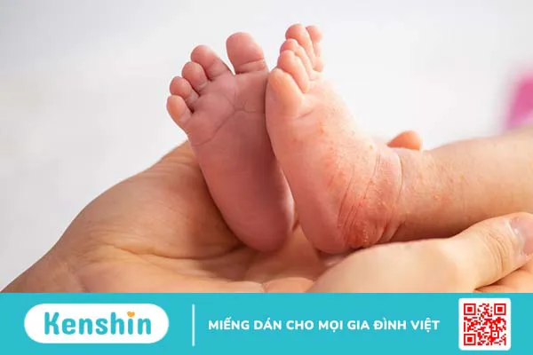 Mẹ bầu bị đậu mùa khỉ có nguy hiểm đến sức khỏe thai nhi không? 4