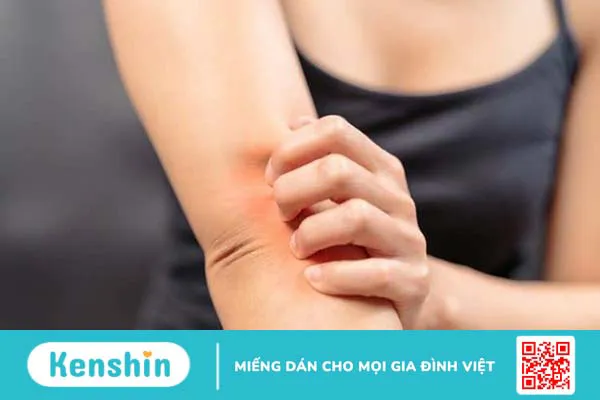 Mẹo chữa bệnh vẩy nến bằng lòng đỏ trứng gà tại nhà