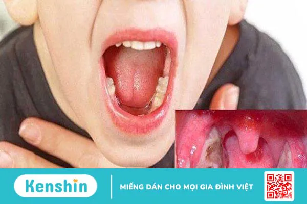 Mẹo chữa viêm họng cho bé không dùng kháng sinh mà bố mẹ nên biết