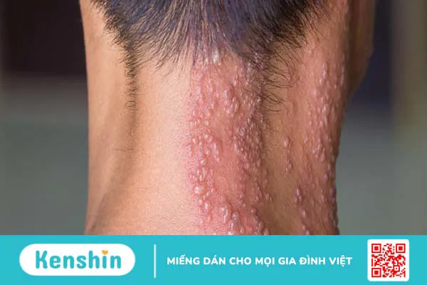 Mẹo dân gian: Trị giời leo bằng đậu xanh 1