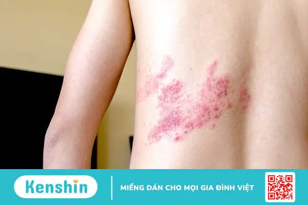 Mẹo dân gian: Trị giời leo bằng đậu xanh 2