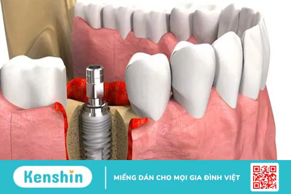 Mổ ghép xương bao lâu thì lành?