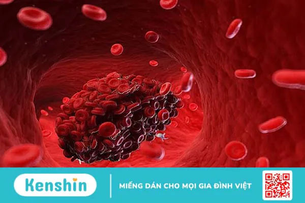 Mọi điều cần biết về hội chứng suy nút xoang tim 2