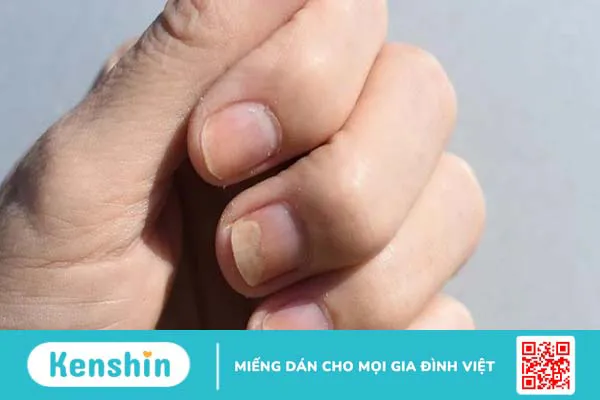 Móng tay bị tụt dần là dấu hiệu của bệnh gì và cách điều trị?