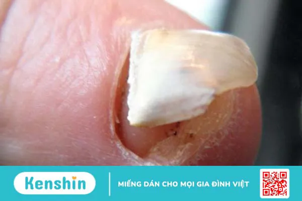 Móng tay bị tụt dần là dấu hiệu của bệnh gì và cách điều trị? 1