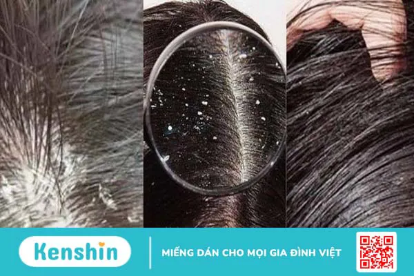 Một số thông tin về dầu gội làm sạch gàu Vichy Dercos