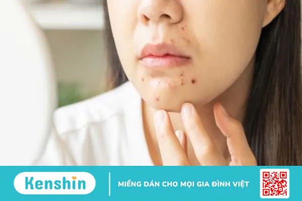 Mụn cám ở cằm: Nguyên nhân, dấu hiệu và cách điều trị